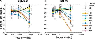 Effects of acute ischemic stroke on binaural perception